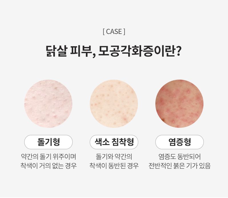 돌기형, 색소 침착형, 염증형 3가지로 나뉘는 모공각화증 / 이미지 출처: 유앤아이의원