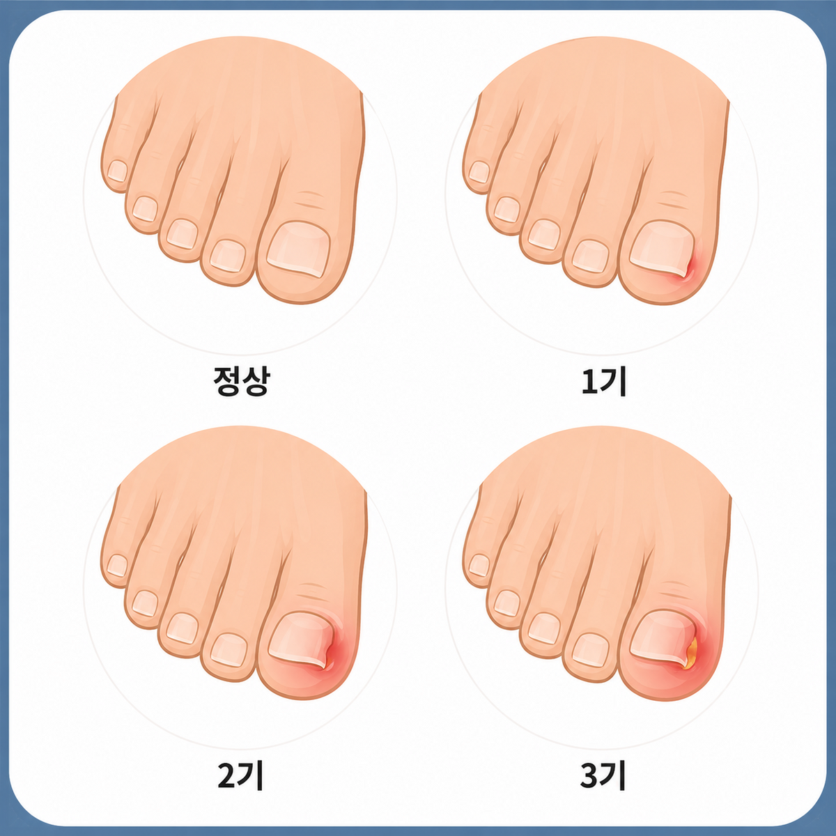 노란 고름이나 악취가 나거나, 붉은 살점이 과도하게 부풀거나, 당뇨병이나 면역저하 질환이 있는 경우는 병원 방문. / 이미지 출처: 생성형 AI