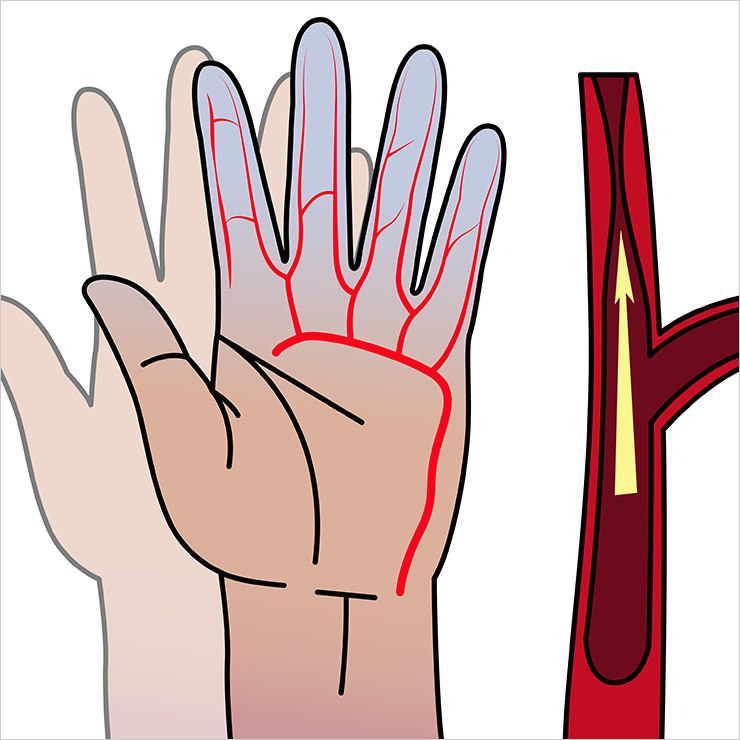 겨울 불청객 수족냉증을 일으키는 원인