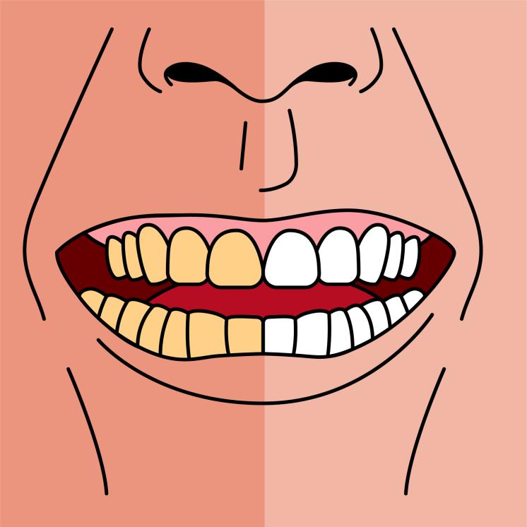 술 마시고 양치 안 하면 입속에서 발생하는 심각한 일